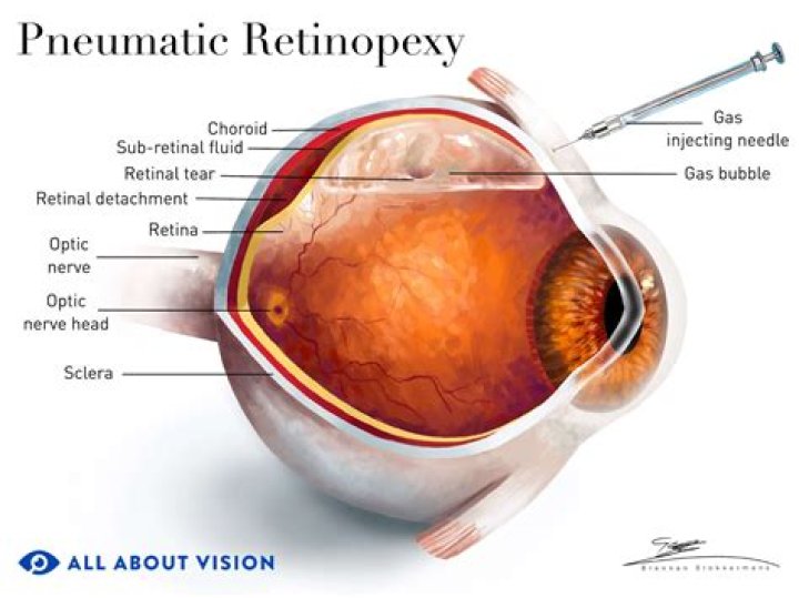 
Abner Mares Right Eye Injury As He Prepares Comeback From Detached Retina 