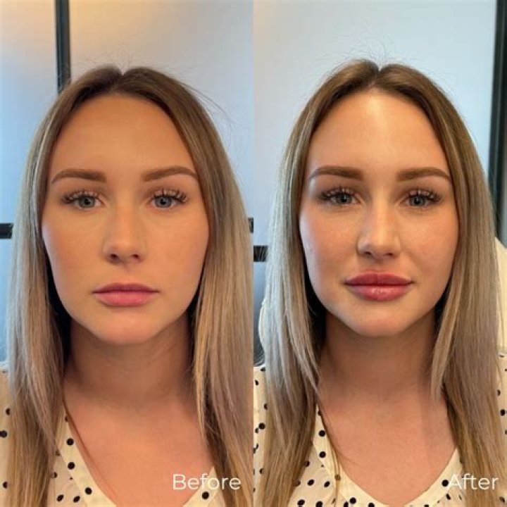 Jennifer Coolidge Botox And Lip Filler – Before And After Photos, Beauty Secret Explored!